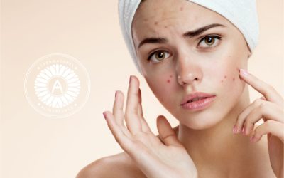 Découvrez la routine idéale pour une peau sans acné